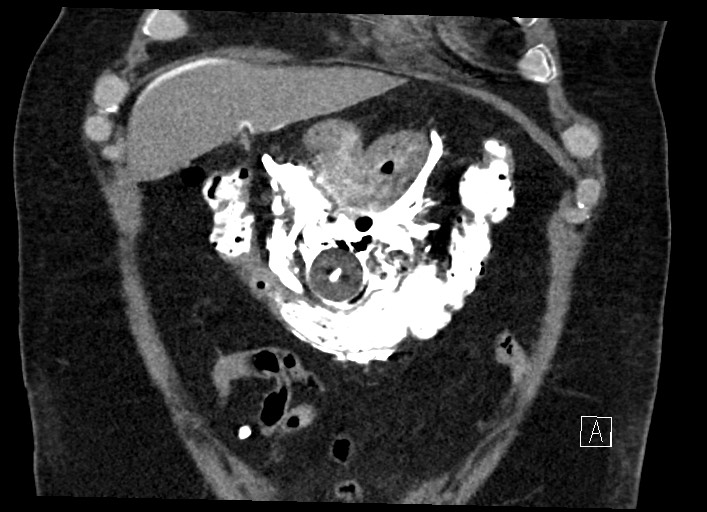 Buried bumper syndrome - gastrostomy tube (Radiopaedia 63843-72577 Coronal Inject 32).jpg