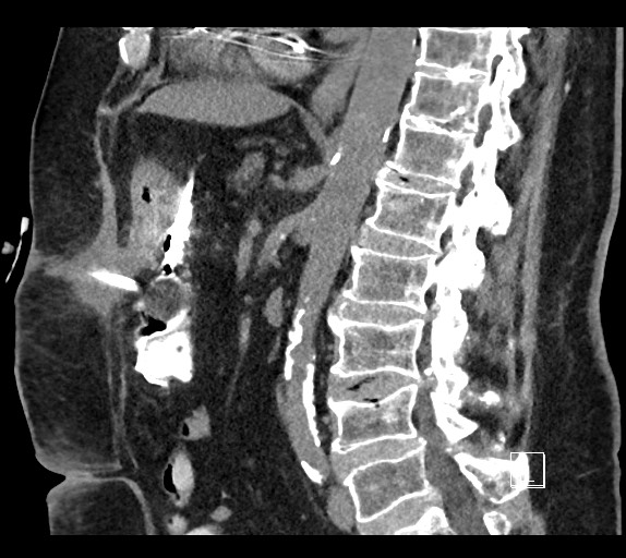 Buried bumper syndrome - gastrostomy tube (Radiopaedia 63843-72577 Sagittal Inject 57).jpg