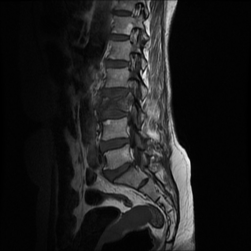 File:Burst fracture - lumbar spine (Radiopaedia 72877-83541 Sagittal T1 7).jpg