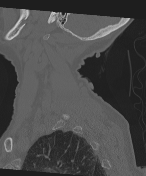 C2 fracture with vertebral artery dissection (Radiopaedia 37378-39199 Sagittal bone window 14).png