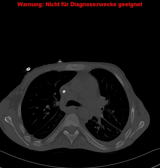 File:Calcific constrictive pericarditis (Radiopaedia 24701-24967 Axial bone window 4).jpg