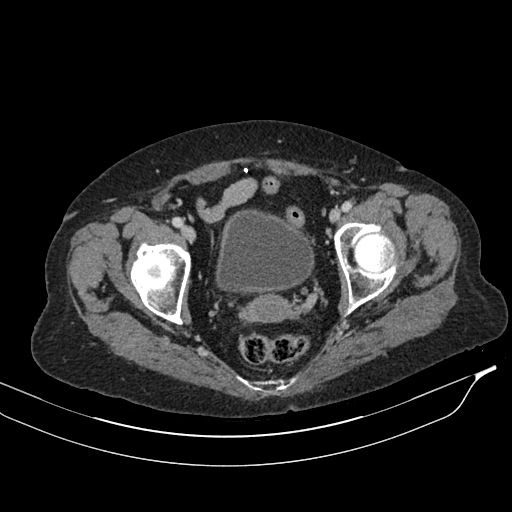 Calcified adrenal glands and Spigelian hernia (Radiopaedia 49741-54988 A 219).jpg