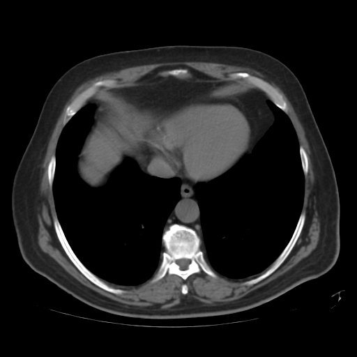 File:Calcified hepatic hydatid cyst (Radiopaedia 18907-18853 Axial non-contrast 1).jpg