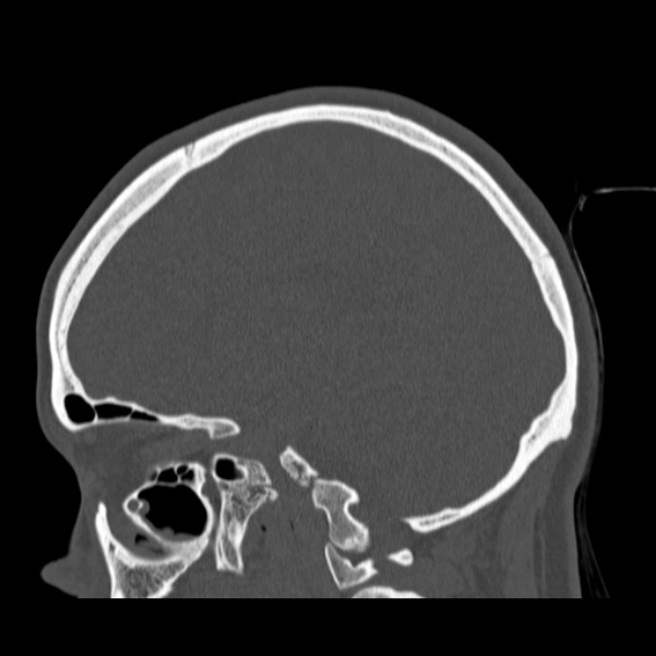 Calvarial osteoma (Radiopaedia 36520-38079 Sagittal bone window 46).jpg