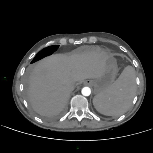 Cannonball metastases (Radiopaedia 82110-96150 Axial C+ CTPA 272).jpg