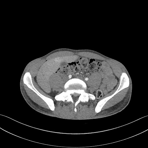 Cannonball metastases - testicular choriocarcinoma (Radiopaedia 84510-99891 B 155).jpg