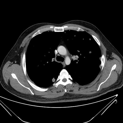 File:Cannonball pulmonary metastases (Radiopaedia 67684-77101 D 101).jpg
