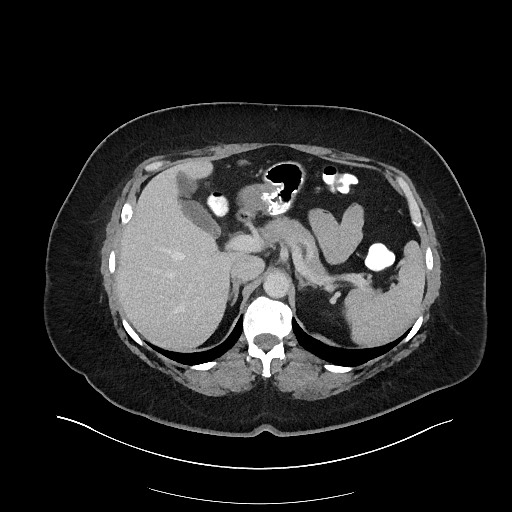 File:Carcinoid tumor - terminal ileum (Radiopaedia 60931-68739 A 36).jpg