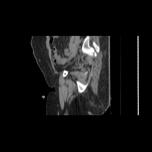 File:Carcinoma cervix- brachytherapy applicator (Radiopaedia 33135-34173 D 41).jpg