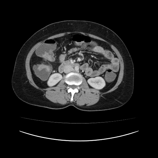 Carcinoma colon - hepatic flexure (Radiopaedia 19461-19493 A 60).jpg
