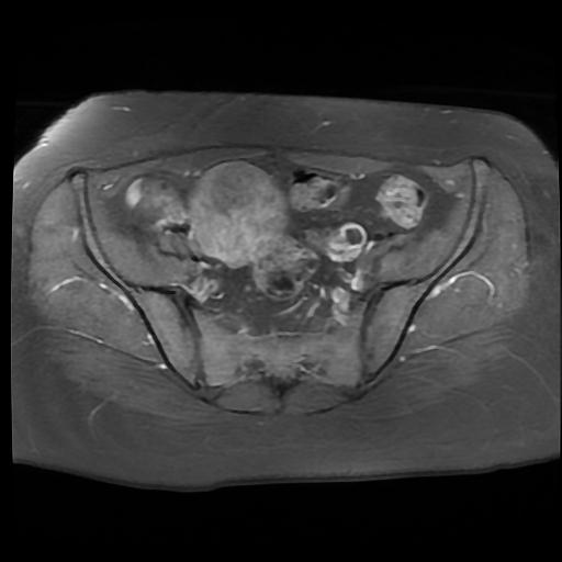File:Carcinoma of the cervix (Radiopaedia 89018-105858 Axial T1 C+ fat sat 4).jpg