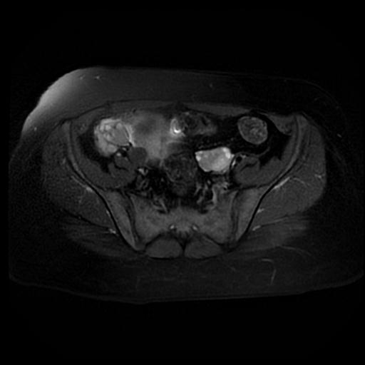 File:Carcinoma of the cervix (Radiopaedia 89018-105858 Axial T2 fat sat 3).jpg