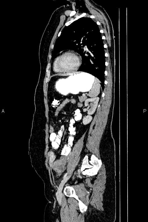 Carcinoma of uterine cervix (Radiopaedia 85861-101700 D 59).jpg