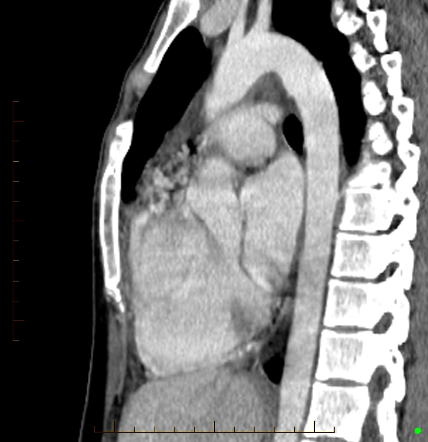 Cardiac paraganglioma (Radiopaedia 76345-88005 C 52).jpg