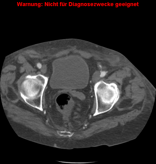 File:Cardiac perforation following transcatheter aortic valve implantation (Radiopaedia 23714-23863 B 4).png