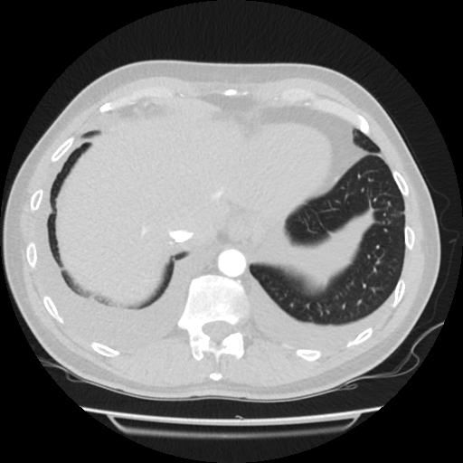 File:Cardiac tamponade (Radiopaedia 78607-91368 Axial lung window 80).jpg