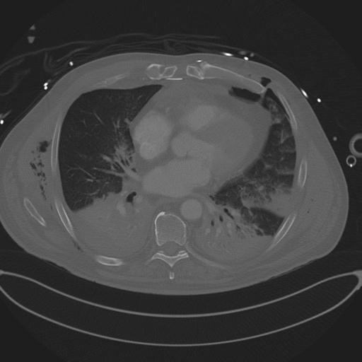 Cardiac trauma (Radiopaedia 32874-33858 Axial bone window 54).jpg
