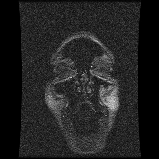 Carotid arterial dissection with acute cerebral infarction (Radiopaedia 26636-26784 MRV 148).jpg