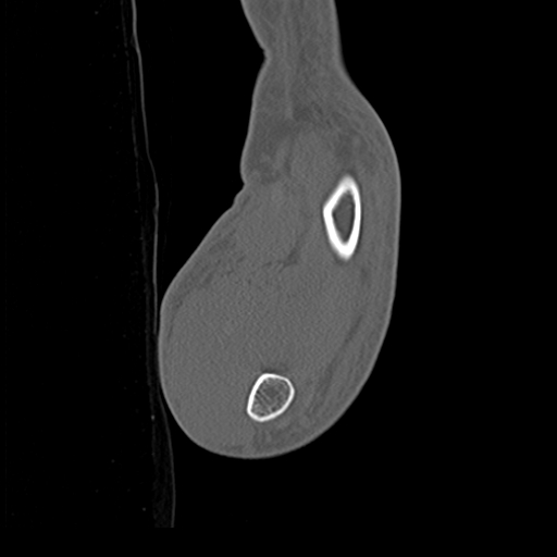 File:Carpo-metacarpal fracture-dislocations with hamatum split fracture (Radiopaedia 18482-18343 Sagittal bone window 32).jpg