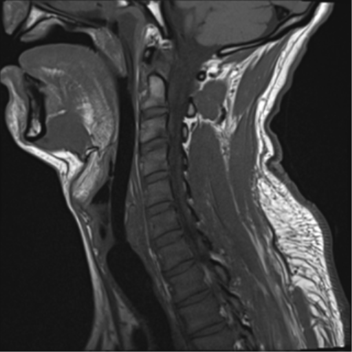 File:Cavernoma of cervical cord (Radiopaedia 50838-56347 Sagittal T1 10).png