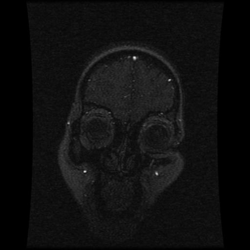 Cavernoma with developmental venous anomaly (Radiopaedia 22470-22507 MRV 109).jpg