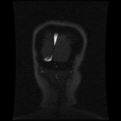 Cavernoma with developmental venous anomaly (Radiopaedia 22470-22507 MRV 27).jpg