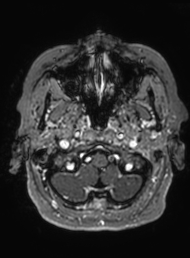 Cavernous hemangioma of the cerebellar falx (Radiopaedia 73025-83724 Axial T1 C+ 309).jpg