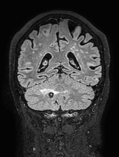 Cavernous hemangioma of the cerebellar falx (Radiopaedia 73025-83724 Coronal FLAIR 246).jpg