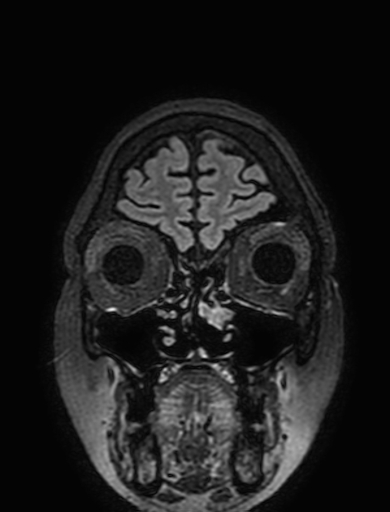 Cavernous hemangioma of the cerebellar falx (Radiopaedia 73025-83724 Coronal FLAIR 35).jpg