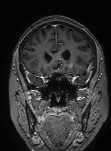 Cavernous hemangioma of the cerebellar falx (Radiopaedia 73025-83724 Coronal T1 C+ 120).jpg