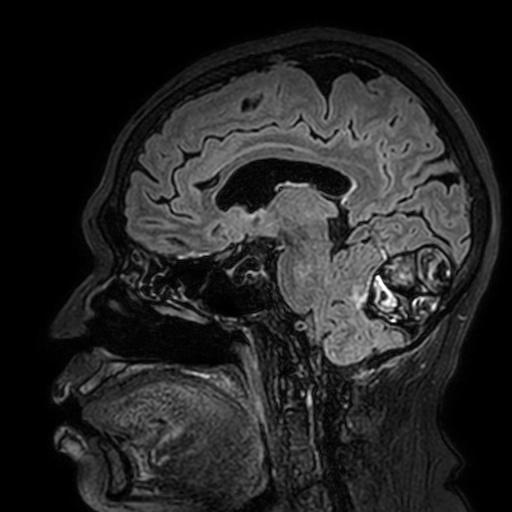 File:Cavernous hemangioma of the cerebellar falx (Radiopaedia 73025-83724 Sagittal FLAIR 120).jpg
