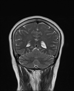 File:Cavernous sinus meningioma (Radiopaedia 63682-72367 Coronal T2 16).jpg