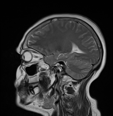 File:Cavernous sinus meningioma (Radiopaedia 63682-72367 Sagittal T2 14).jpg