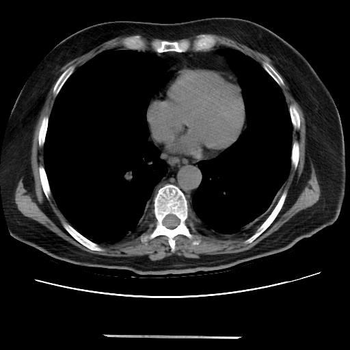 Cavitating pulmonary metastases (Radiopaedia 89545-106544 Axial non-contrast 37).jpg