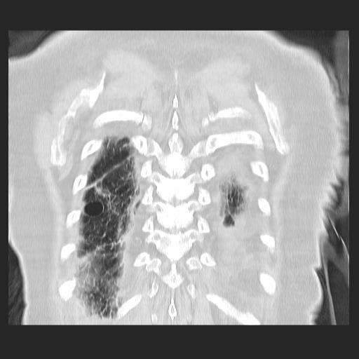 File:Cavitating pulmonary metastases (Radiopaedia 89545-106544 Coronal lung window 40).jpg
