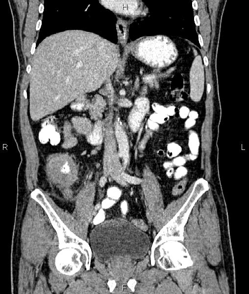 Cecal cancer with appendiceal mucocele (Radiopaedia 91080-108651 D 38).jpg