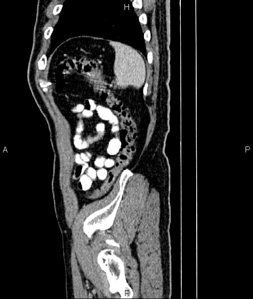 File:Cecal cancer with appendiceal mucocele (Radiopaedia 91080-108651 E 84).jpg