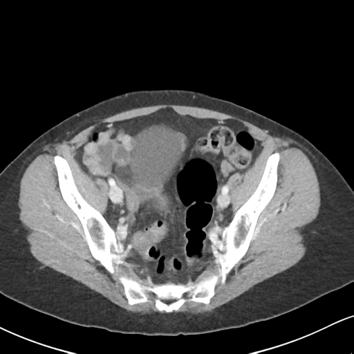 Cecal internal hernia through the foramen of Winslow (Radiopaedia 44820-48651 B 62).png