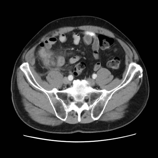 Cecal mass causing appendicitis (Radiopaedia 59207-66531 A 65).jpg