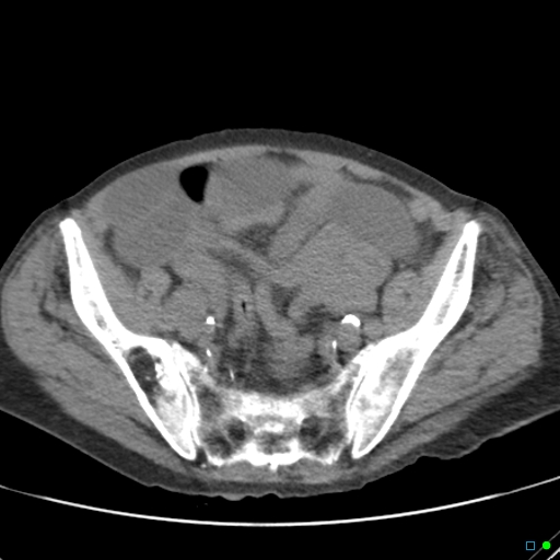Cecal volvulus - atypical (Radiopaedia 21637-21588 non-contrast 56).jpg