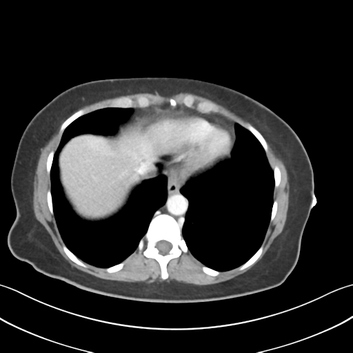 Cecum hernia through the foramen of Winslow (Radiopaedia 46634-51112 A 9).png