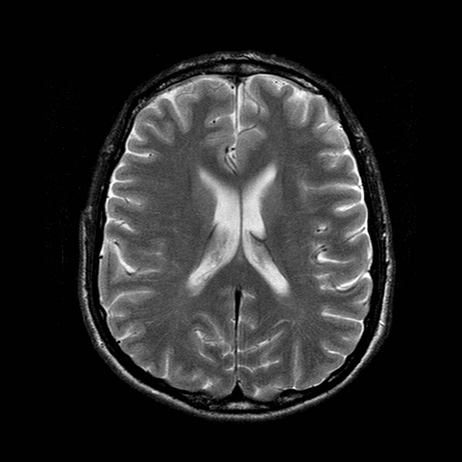 File:Central-variant posterior reversible encephalopathy syndrome (PRES) (Radiopaedia 43880-47359 Axial T2 14).jpg
