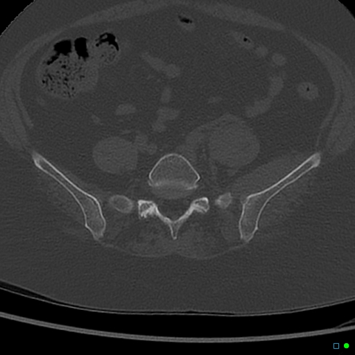 Central fracture-dislocation of the acetabulum (Radiopaedia 36578-38150 Axial bone window 4).jpg