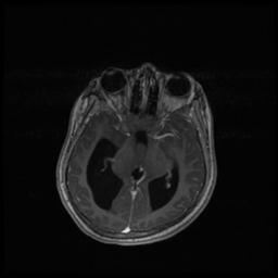 Central neurocytoma (Radiopaedia 30220-30842 Axial T1 C+ 65).jpg