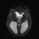 Central neurocytoma (Radiopaedia 56690-63469 Axial DWI 8).jpg