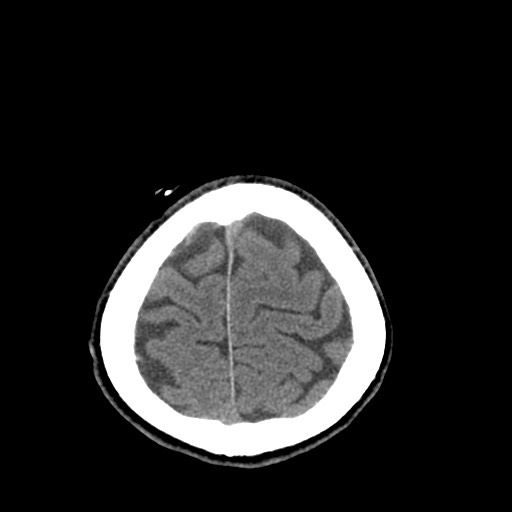 File:Central neurocytoma (Radiopaedia 68725-78432 Axial non-contrast 48).jpg