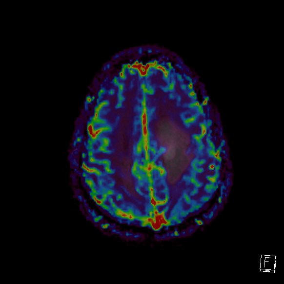 Central neurocytoma (Radiopaedia 84497-99872 Axial Perfusion 71).jpg