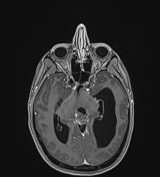 File:Central neurocytoma (Radiopaedia 84497-99872 Axial T1 C+ 65).jpg