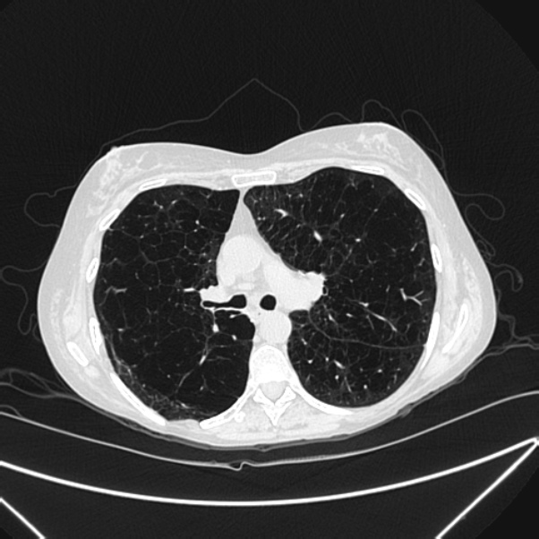 Centrilobular pulmonary emphysema (Radiopaedia 24495-24789 Axial lung window 40).jpg