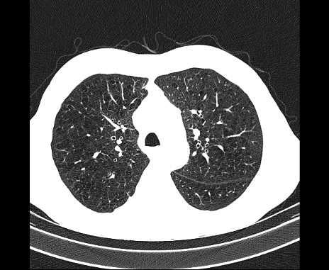 Centrilobular pulmonary emphysema (Radiopaedia 62468-70718 Axial lung window 24).jpg